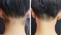 Skin Brightening Results - Before & After