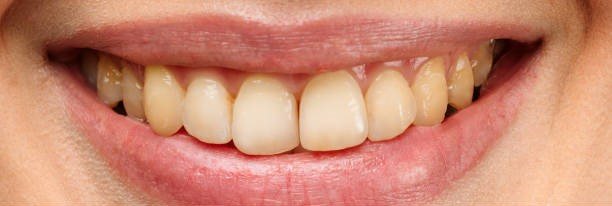 Before teeth whitening